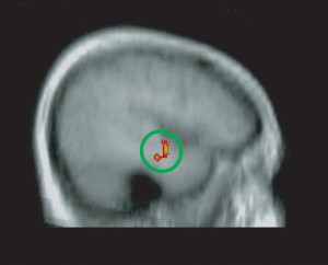 Functional magnetic resolution image showing location of increased brain activity during an aha moment, like those occurring from an insight solution in brain science research